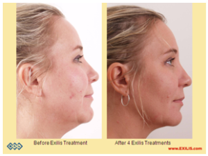 Before and After 4 Exilis Treatments